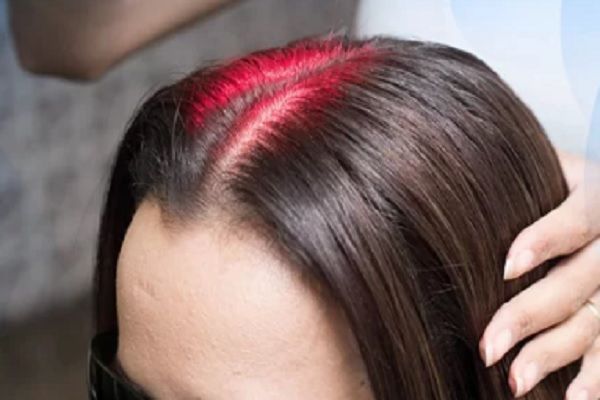 Láser capilar - Joven con efluvio telógeno recibe un tratamiento de bioestimulación capilar para aumentar el volumen de su cabello