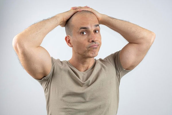 Esteroides anabólicos y alopecia - Hombre musculoso busca tratamientos capilares para estimular el crecimiento del cabello 