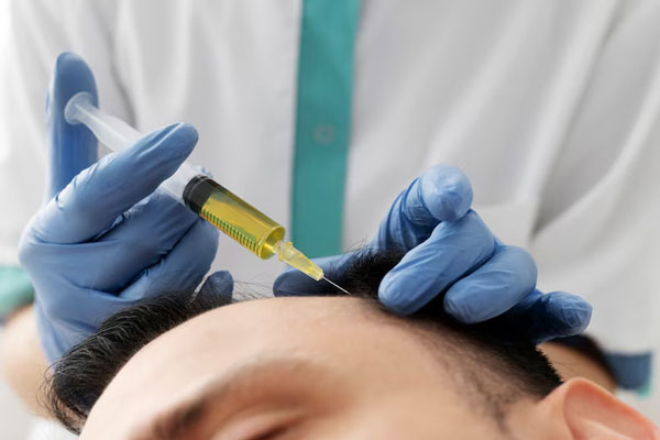Infiltración capilar - Dermatóloga administra un tratamiento de plasma rico en plaquetas para combatir la alopecia 