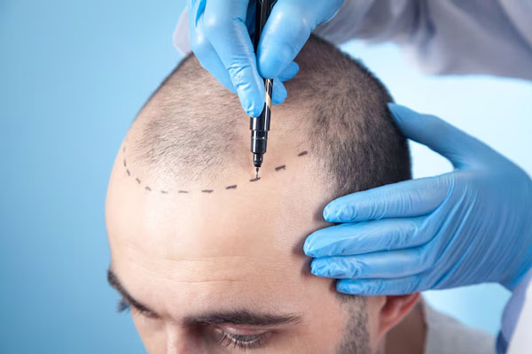 Reparar un injerto capilar - Médico tricólogo realizando el diseño del injerto capilar a un hombre con alopecia androgénica para recuperar la densidad del cabello de forma natural