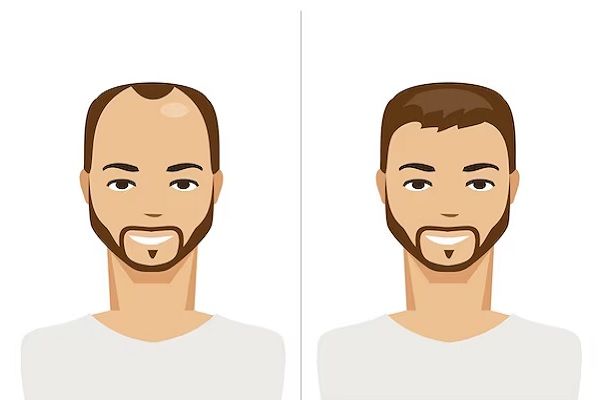 Sistema de integración capilar - Antes y después de un hombre con prótesis capilar