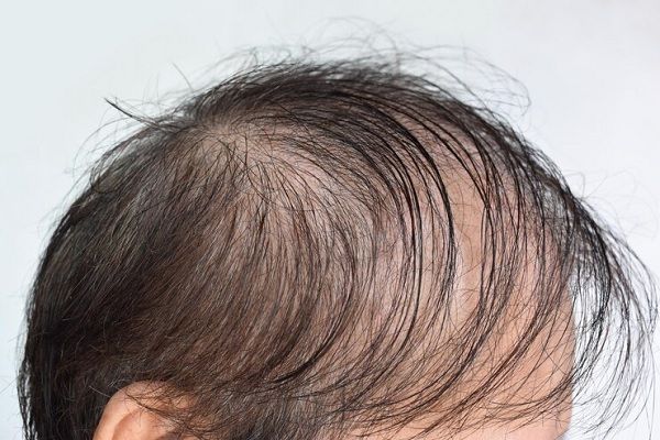 287 genes - Plano detalle de la cabeza de un hombre con alopecia androgénica