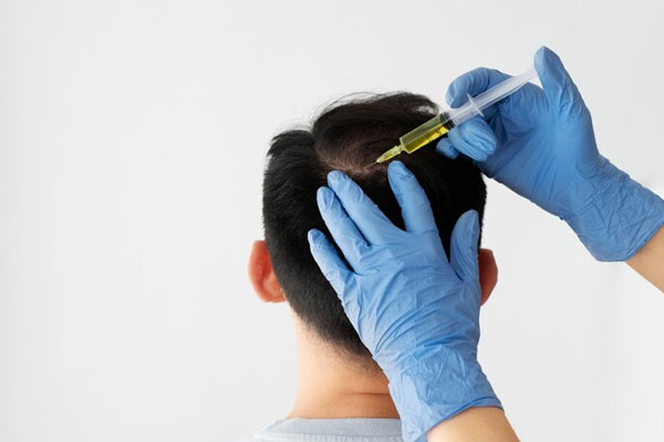 Infiltración capilar - Hombre recibe tratamiento capilar con vitaminas y aminoácidos para combatir la alopecia en el coronilla 