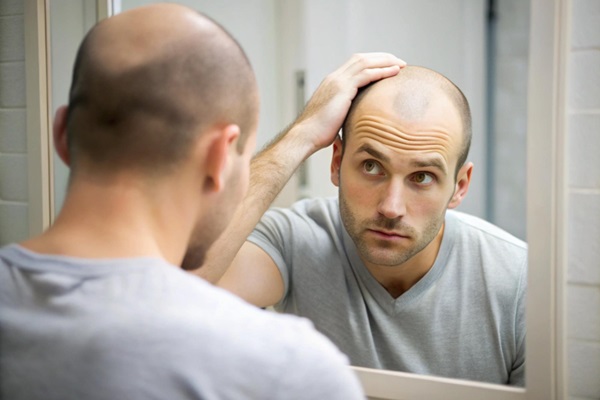 Calvicie y obesidad - Hombre joven observando en el espejo el avance de la calvicie como consecuencia de una mala alimentación