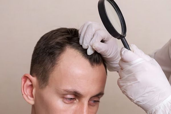 pelo injertado no se cae - tricólogo revisando el cabello de un paciente con claros síntomas de alopecia en las entradas