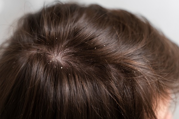 Pelo de los hombres - Vista superior de la cabeza de un hombre con caspa en el cabello