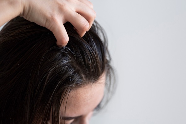 Pelo graso - Mujer rascando su cabello con caspa debido a la excesiva producción de sebo