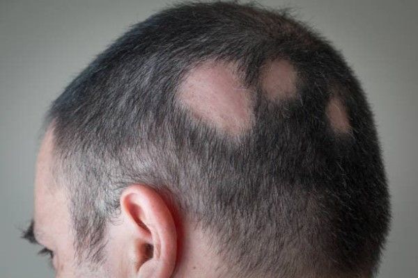 Consejos para personas con alopecia areata