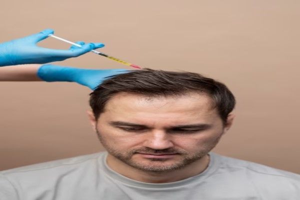 consejos para personas con alopecia areata