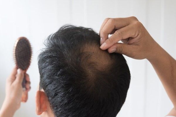 a qué edad se estabiliza la alopecia androgénica