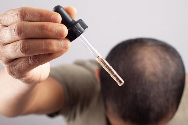 consejos para personas con alopecia areata