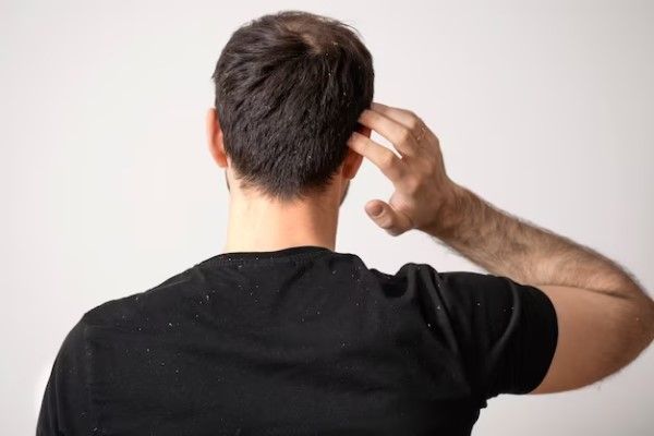 síntomas de calvicie en jovenes