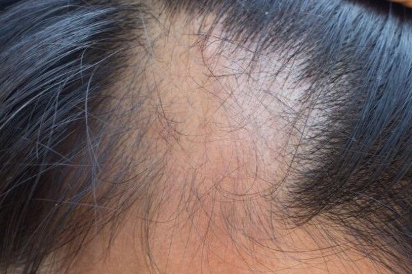 Tipos de alopecia en mujer