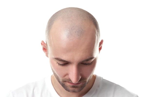 La calvicie en cifras - hombre caucásico con alopecia