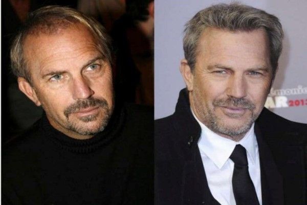 Kevin Costner, antes y despues del injerto capilar