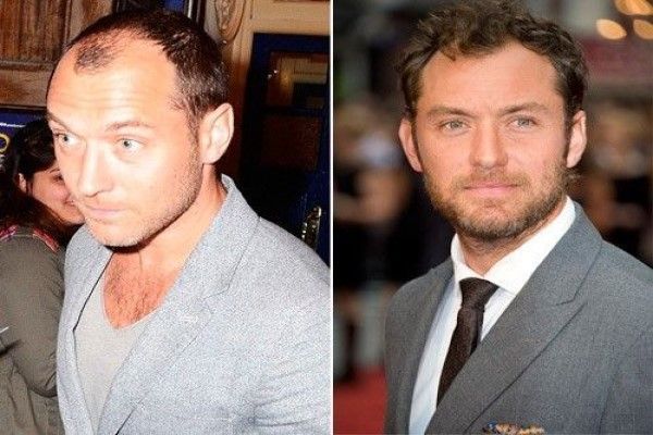 Jude Law, muestra su cabeza antes y depues de realizar el implante de cabello