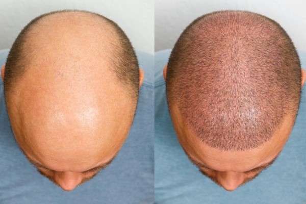 demostración de la precisión de este método al injertar el cabello en las imágenes del antes y del después