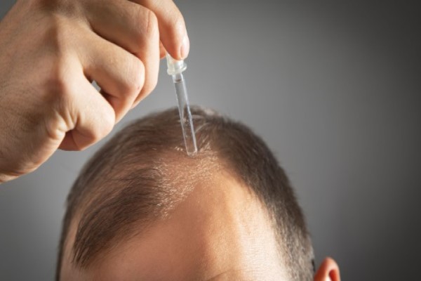 imagen de hombre blanco aplicando un tratamiento para el cuidado del pelo injertado