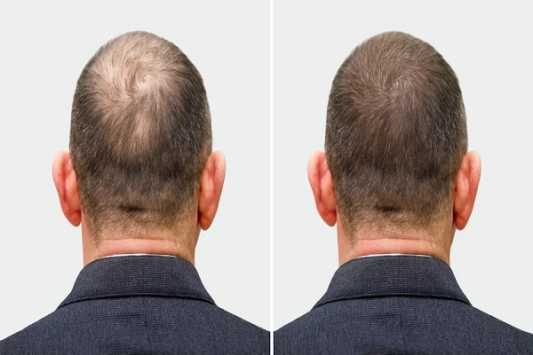 Evolución del injerto capilar- antes y despues del implante capilar
