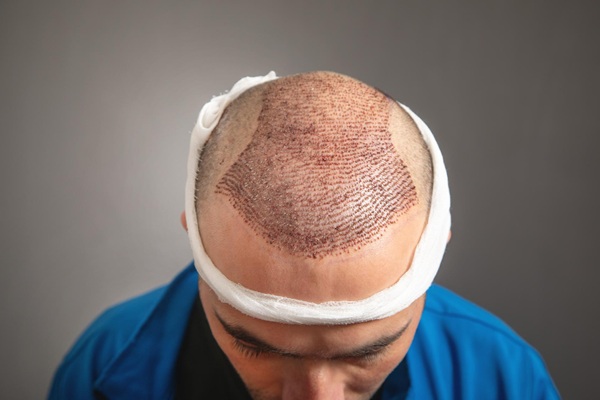 Hombre con vendaje en la cabeza luego de un injerto de cabello CDMX
