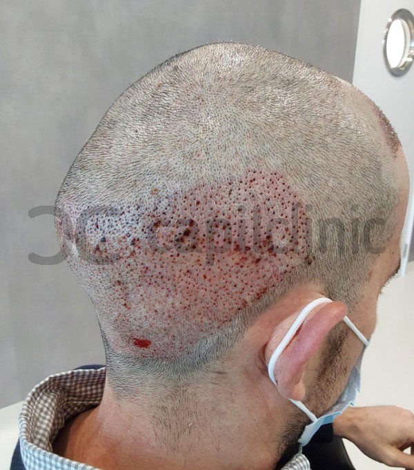 Evolución del injerto capilar - 2do dìa luego de hecho un implante de pelo