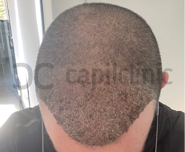 Evolución del injerto capilar- Muestra de recuperación del implante de cabello
