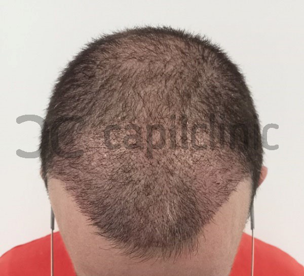 Proceso de recuperación de un trasplante de pelo