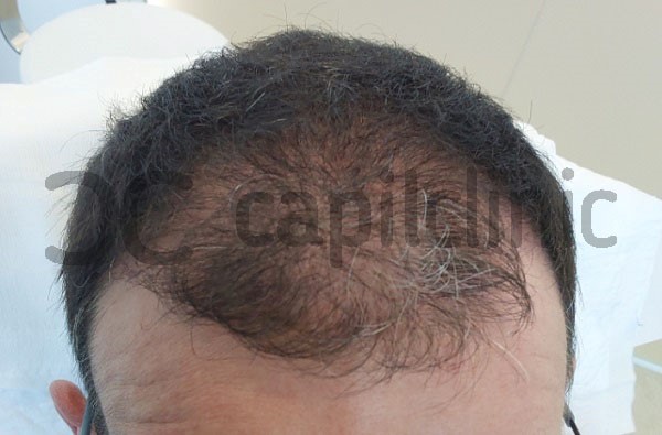 Pelo injertado en proceso de recuperación tras operación