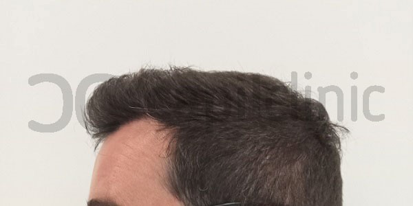 primeros resultados del injerto de cabello