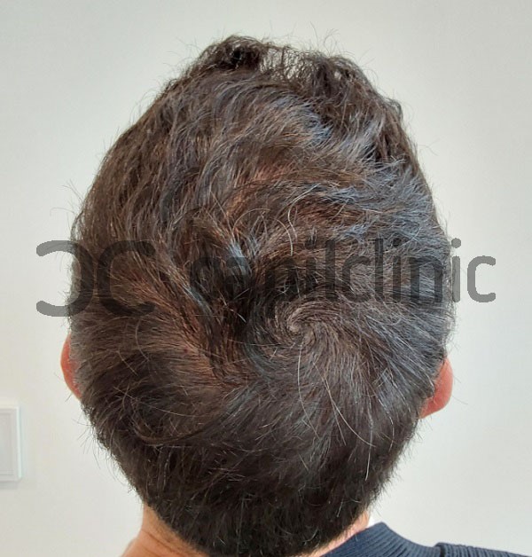 resultados de un trasplante de cabello 10 meses despues