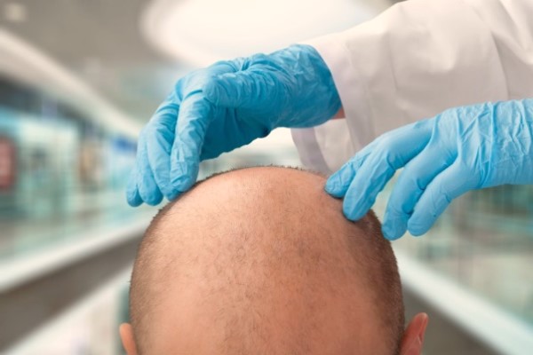 especialistas en cirugía capilar - Paciente de alopecia en la consulta de un especialista en cirugía capilar