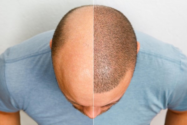 Resultados de un injerto de cabello