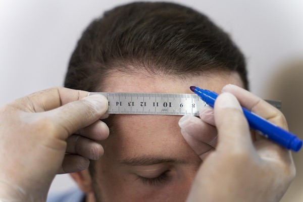 Tricólogo realizando el diseño de la línea frontal del cabello a un hombre con alopecia para determinar el injerto capilar precio