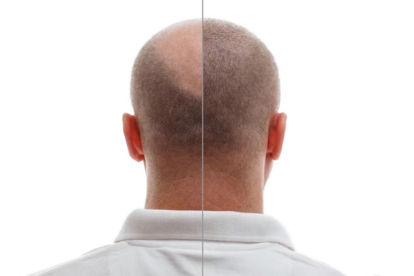 injerto de cabello antes y despues