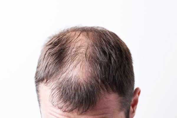 cae el pelo- Cabeza mostrando claros y perdida capilar
