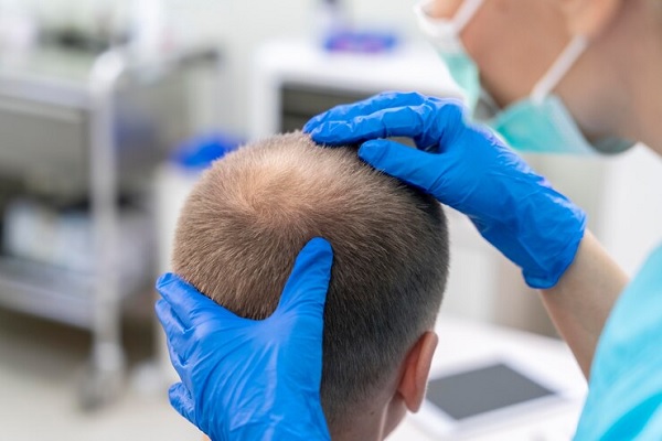 Especialista revisando paciente con alopecia
