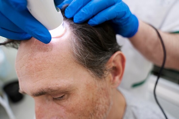 aplicacion de tecnología láser en paciente con alopecia