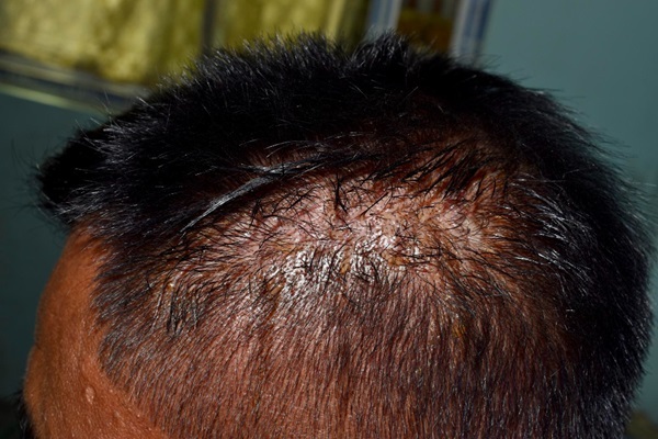 Foliculitis decalvante - Hombre con foliculitis capilar, una infección en el cuero cabelludo que causa descamación y pérdida de cabello