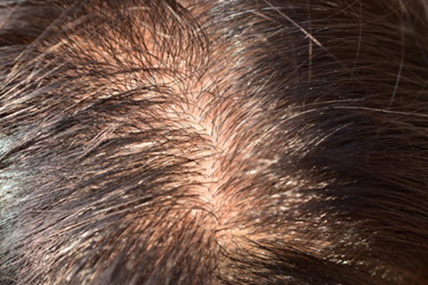 Foliculitis decalvante - Cuero cabelludo con alopecia cicatricial que causa la pérdida de cabello permanente
