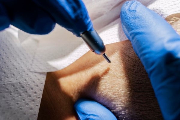 Inflamación tras injerto capilar - Médico tricólogo preparándose para extraer las unidades foliculares de la zona donante mediante el método FUE