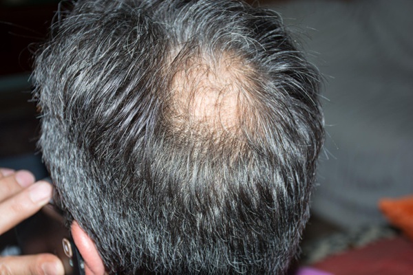 Hombre con pérdida de cabello en la coronilla que se puede solucionar con un trasplante de cabello CDMX