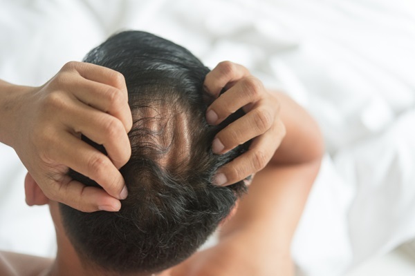 Olumiant - Hombre con pérdida de cabello difusa poniendo las manos en la cabeza