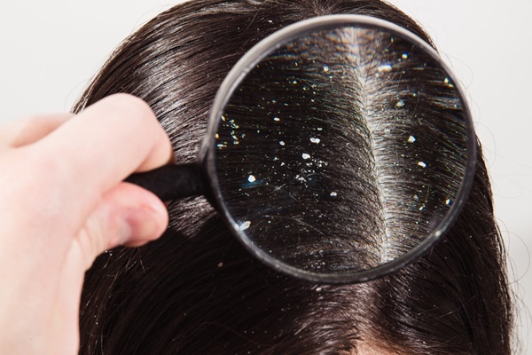 Alteraciones del cuero cabelludo - Persona usando una lupa para observar los problemas del cuero cabelludo que presenta como caspa y dermatitis seborreica