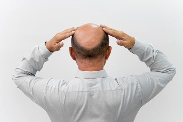 Cáncer y pérdida del pelo - Hombre con pérdida del pelo debido a los tratamientos para el cáncer y la quimioterapia