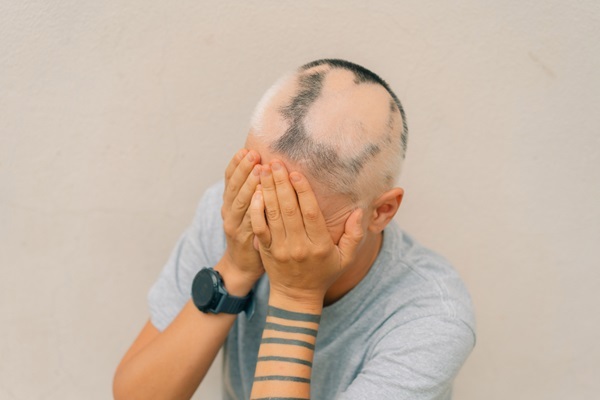 Inhibidores de JAK para la alopecia areata - Persona con pérdida de cabello en parches debido a la alopecia areata tapándose la cara con las manos