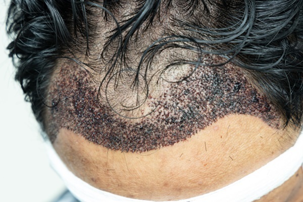 Postoperatorio del trasplante capilar - Hombre con costras en el cuero cabelludo como parte del proceso de cicatrización del implante capilar CDMX