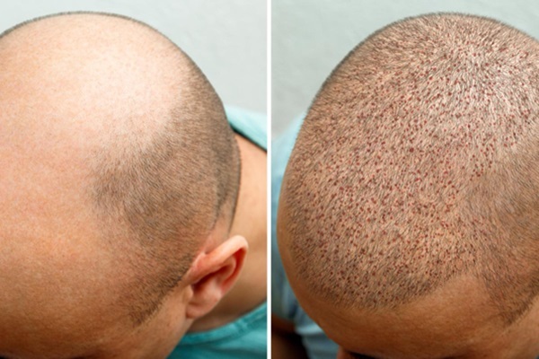 Postoperatorio del trasplante capilar - Comparativa del cuero cabelludo de un hombre con alopecia androgénica luego de un trasplante capilar en Ciudad de México