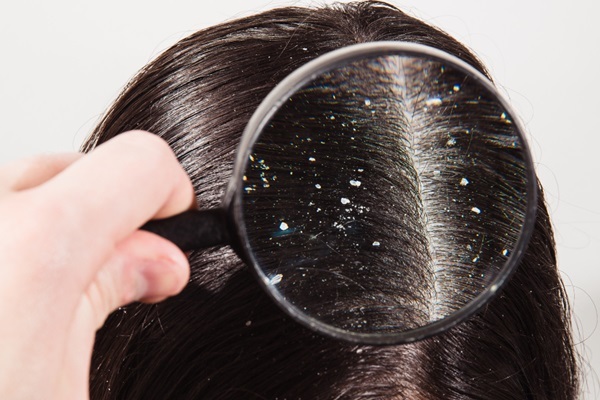 Problemas capilares distintos a la alopecia - Persona acercando una lupa al cuero cabelludo para observar costras blancas en el pelo debido a la caspa y dermatitis seborreica