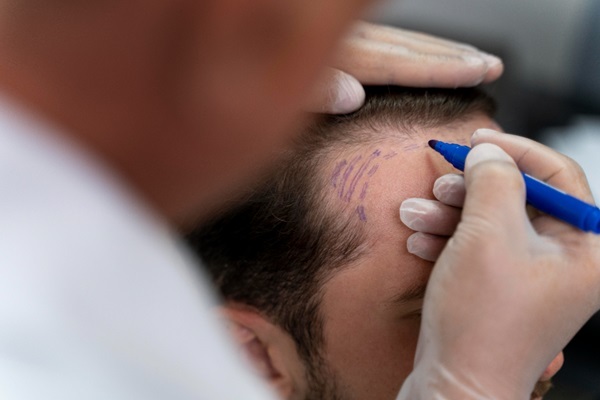 Trasplante de pelo en España - Tricólogo realizando el boceto del injerto de pelo a un hombre con pérdida de cabello en las entradas