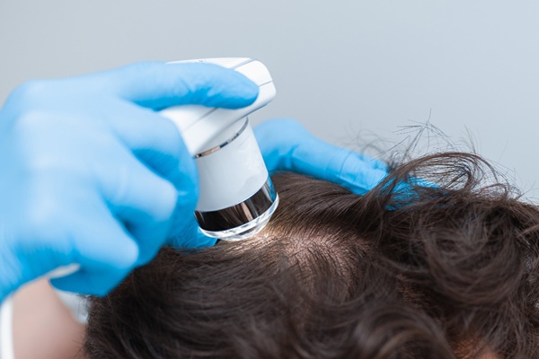 Tricoscopia para diagnóstico de alopecia - Tricólogo utilizando un tricoscopio moderno para evaluar el cuero cabelludo de un paciente y diagnosticar la alopecia